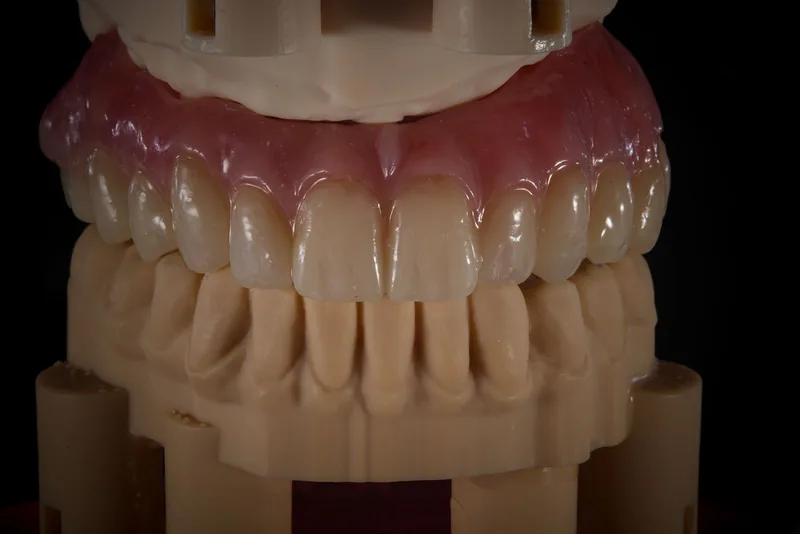 Full-arch case on DACOS Omni printed models
